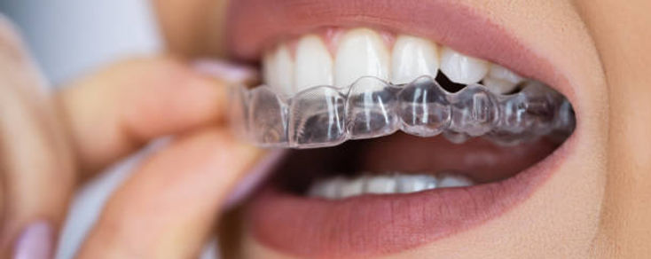Close-up of a person putting in a clear Invisalign aligner