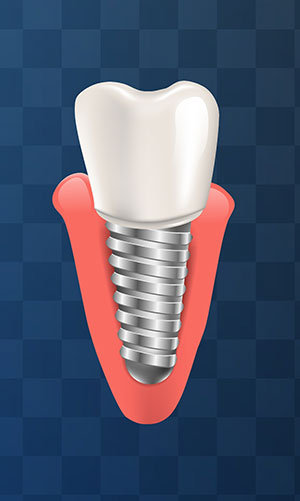 implant