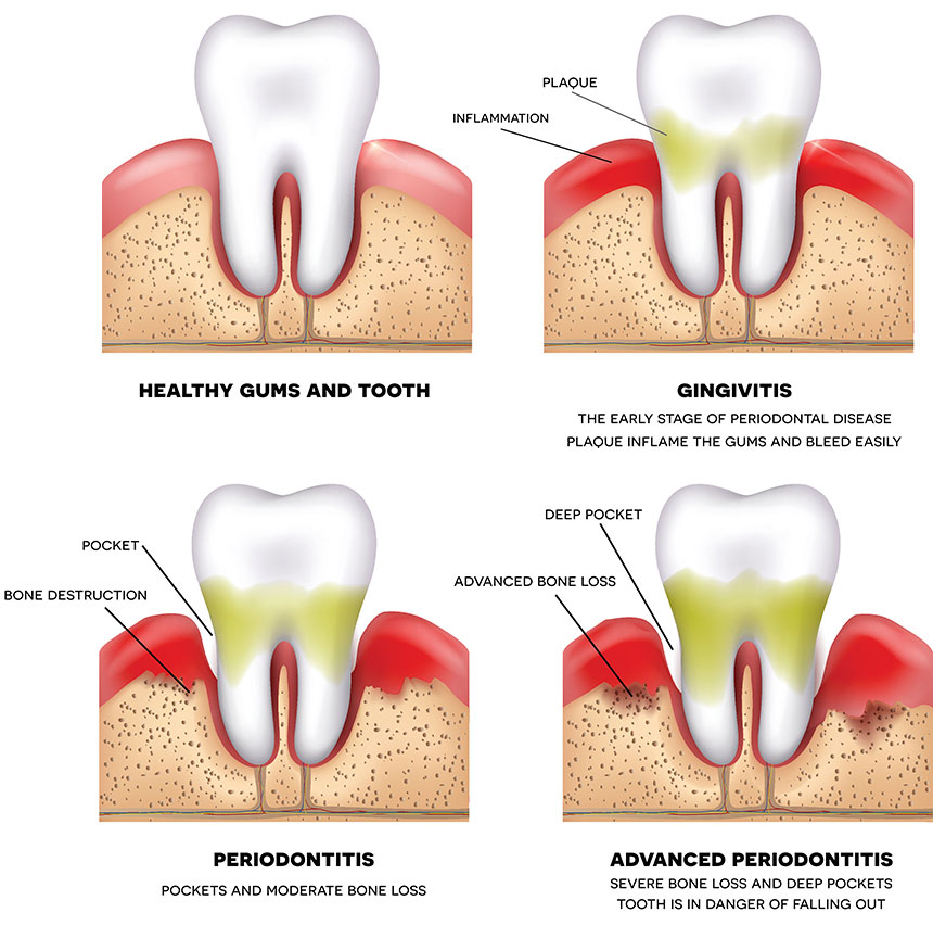 Periodontal Disease